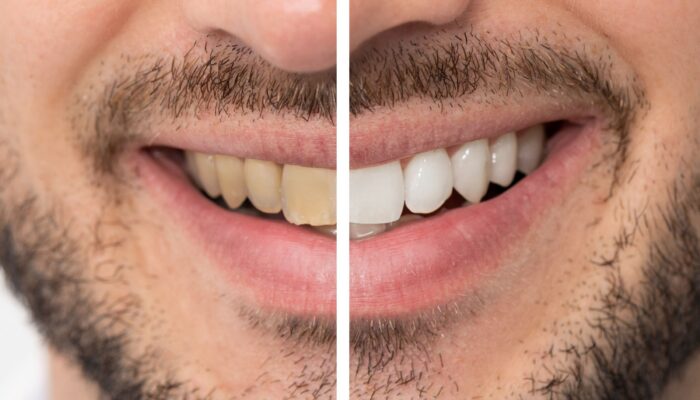 Teeth Reshaping