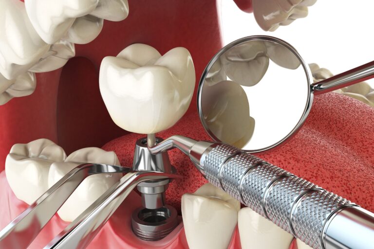 Dental Implants Procedure A StepbyStep Guide Greater Essex Dental