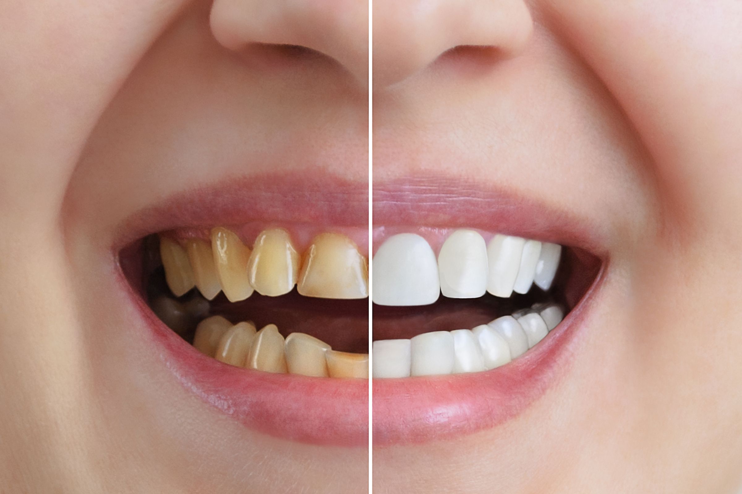 Benefits and Drawbacks Of Teeth Whitening